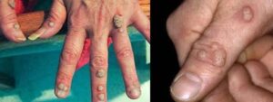 Warts - a common viral infection in the skin