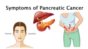 Pancreatic cancer and its link with  Diabetes – What are things that you should know?