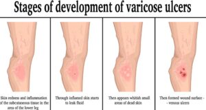 stages-of-development-of-varicose-ulcers