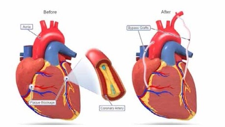 bypass stenting