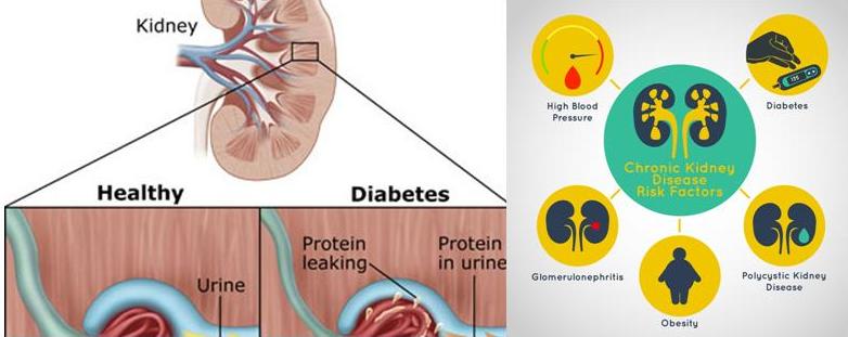 kidney-and-diabetes