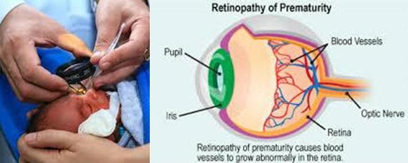 Retinopathy-of-Prematurity
