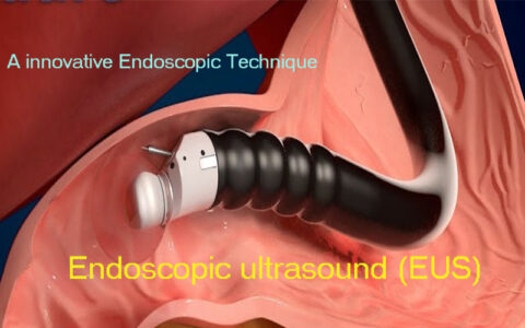 Endoscopic ultrasound (EUS)