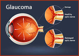 glaucoma-eye