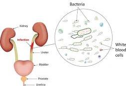 urinary-infection.
