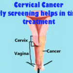 Cervical Cancer : Early screening helps in timely treatment