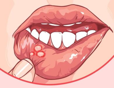 Mouth Ulcers: Home remedies
