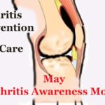 Prevention and self care of Arthritis key to healthcare