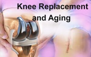  Knee Replacement and Aging