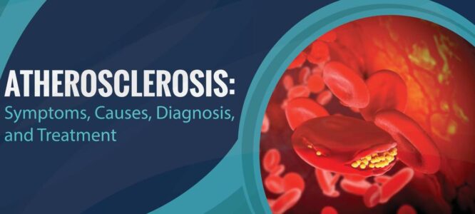 Atherosclerosis-Symptoms-Causes-Diagnosis-and-Treatment - Health Vision