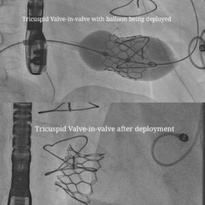 Fluoroscopic-Image-showing-the-Tricuspid-valve-invalve-in-situ