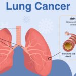 Study by National Institutes of Health illuminates origins of lung cancer who do not have history of smoking