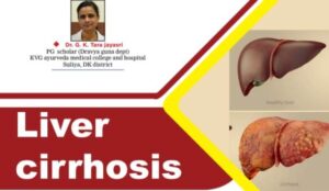 Liver cirrhosis treatment in Ayurveda