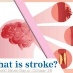Stroke disorder is a state of medical emergency