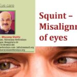 Squint or Misalignment of eyes -  Is it a cosmetic issue or a serious eye condition?