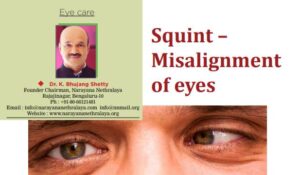 Squint or Misalignment of eyes - Is it a cosmetic issue or a serious eye condition?