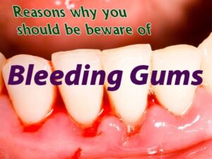 Bleeding Gums can  be a sign of leukemia and must not be ignored.