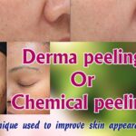 Derma peeling or Chemical peeling - technique used to improve skin appearance