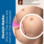 Stretch marks: Why do they occur and how can they disappear!