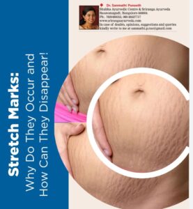 Stretch marks: Why do they occur and how can they disappear!