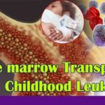 Bone Marrow Transplant to treat challenging childhood Leukaemia