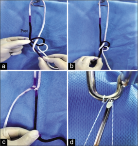 The Banarji’s Knot - Doctor at Sakra World Hospital invents a new form of Arthroscopy knot