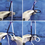 The Banarji’s Knot - Doctor at Sakra World Hospital invents a new form of Arthroscopy knot