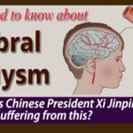 Cerebral Aneurysm - All that you need to know about the condition Chinese president Xi Jinping is suffering from