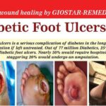 Diabetic Foot Ulcers - Advanced wound healing by GIOSTAR-REMED