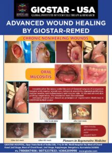Diabetic Foot Ulcers, Chronic Wounds and Oral Mucositis - Advanced wound healing by GIOSTAR-REMED