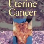Risk of uterine cancer among Menopausal Women