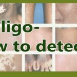 Vitiligo - how to detect and signs people should look out for