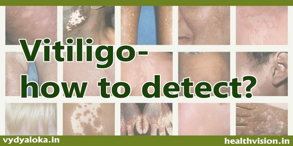 The Many Faces of Vitiligo - Next Steps in Dermatology