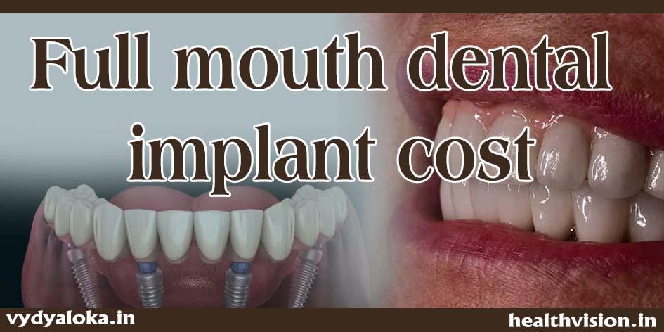 Full mouth dental implant : The popular teeth replacement technique