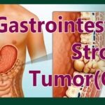 Abdominal pain and loss of appetite can be a sign of Gastrointestinal Stromal Tumour (GIST)