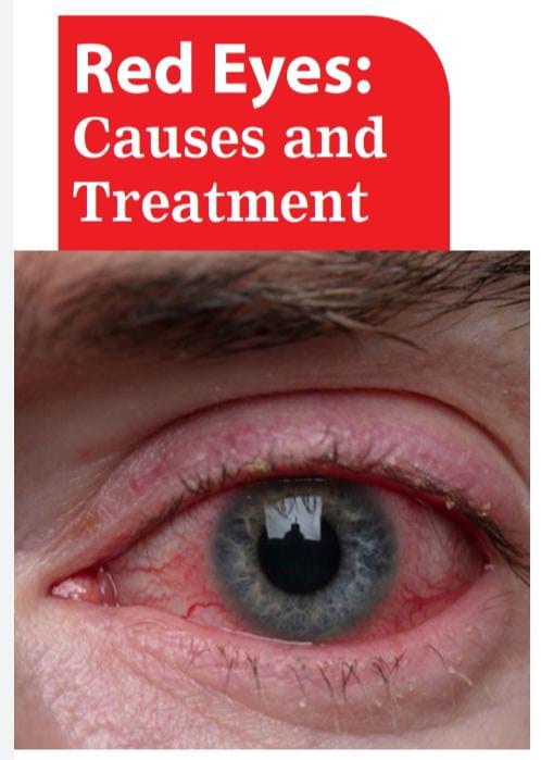 Red Eyes: Causes and Treatment