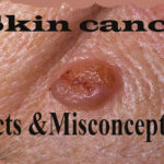 Fact checking the misconceptions about Skin cancer