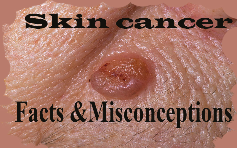 Skin cancer - facts and myths