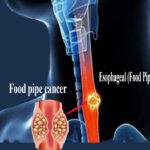 Esophageal (Food Pipe) Cancer - Symptoms and Preventions