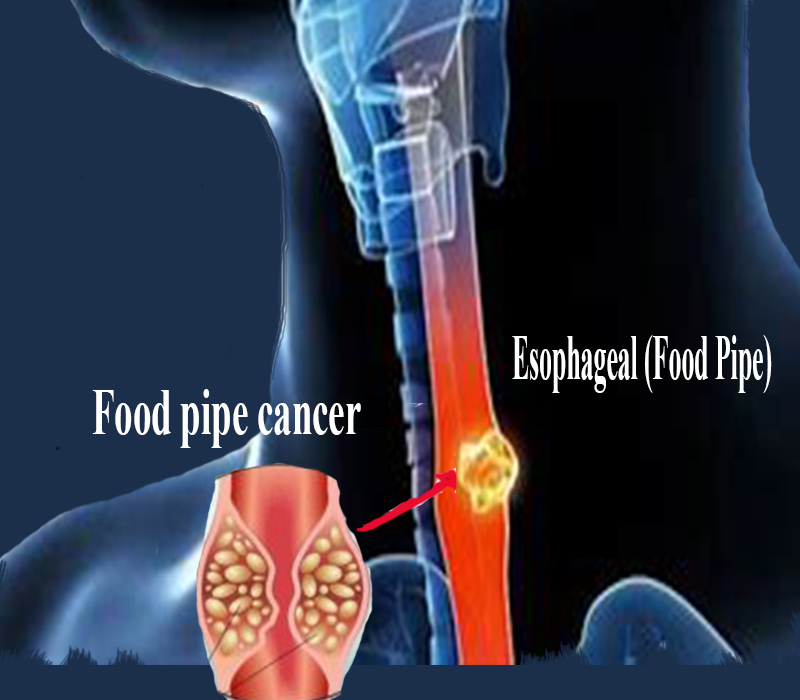 esophagus cancer xray