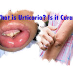 What is Urticaria? Is it Curable?