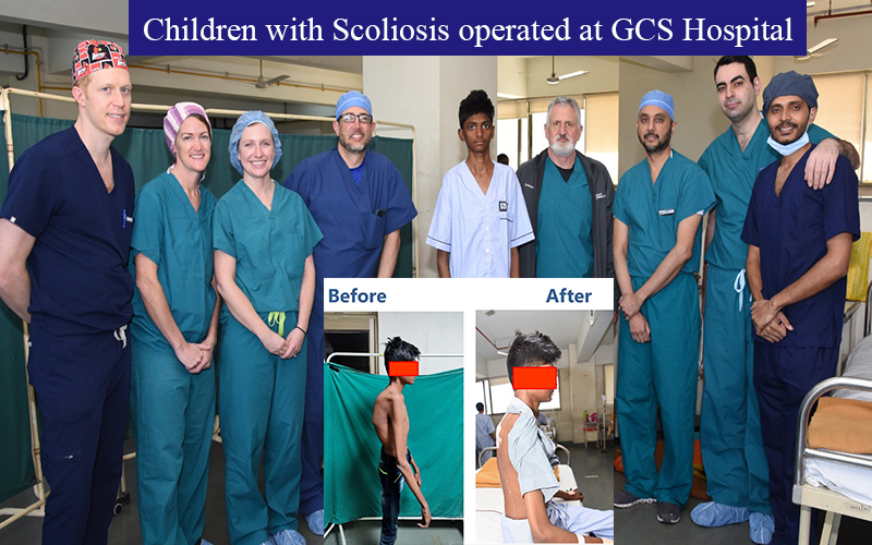 children with scoliosis operated at GCS Hospital