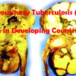 Genitourinary Tuberculosis (TB) on the Rise in Developing Countries