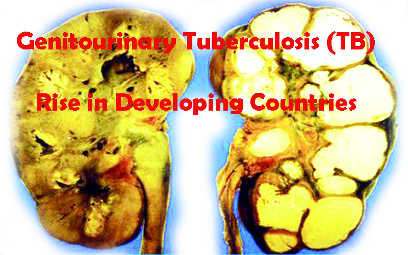 Genitourinary Tuberculosis (TB) on the Rise in Developing Countries