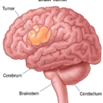 What is a brain tumor - 8th June - World Brain Tumor Day