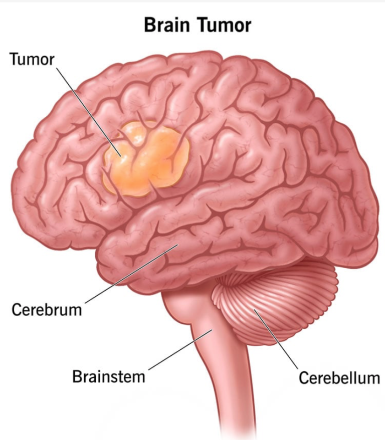 what-is-a-brain-tumor-8th-june-world-brain-tumor-day