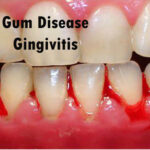 Gum Disease – Gingivitis