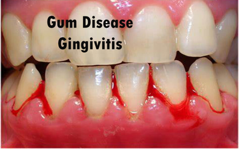 Gum Disease – Gingivitis