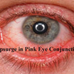 Upsurge in Pink Eye Conjunctivitis