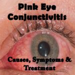 Understanding Pink Eye Conjunctivitis - Causes and Treatment